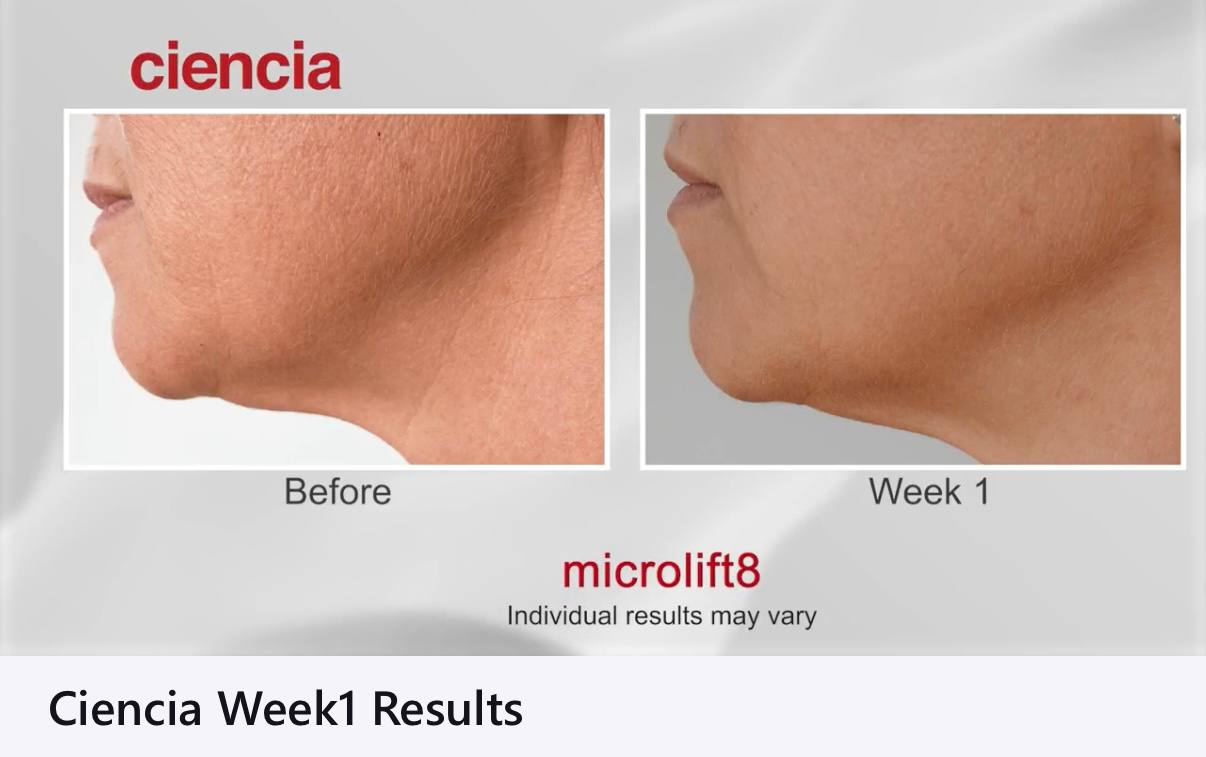 Microlift8 Before and After - Chin and Jawline Week 1 Results