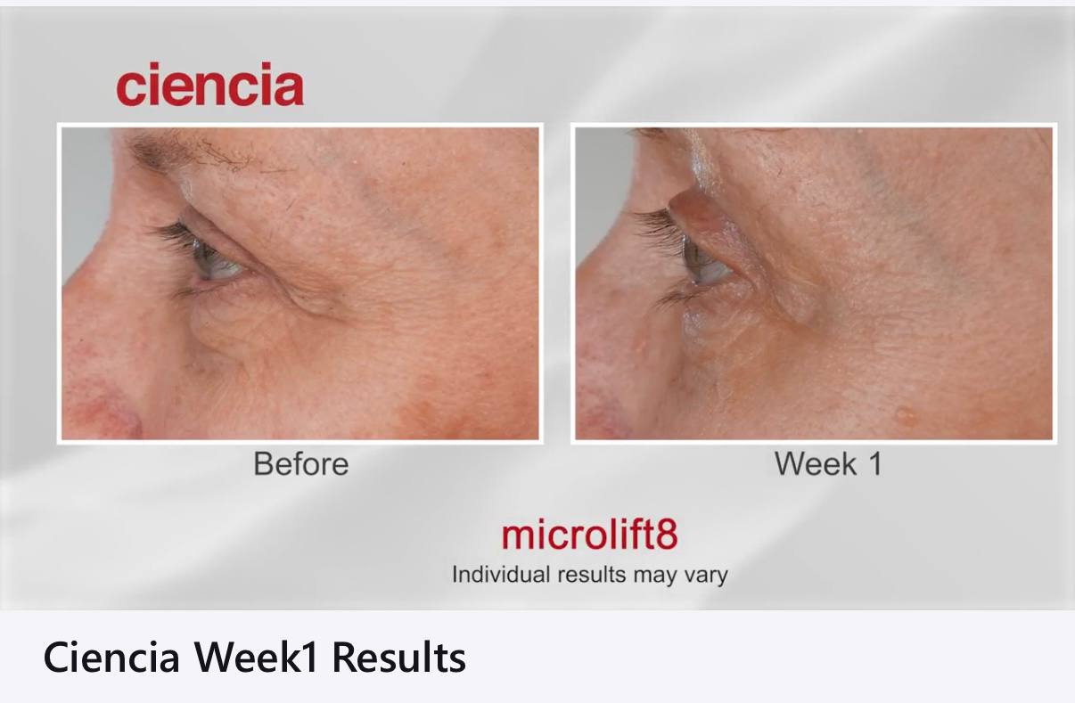 Microlift8 Before and After - Eye Area Week 1 Results