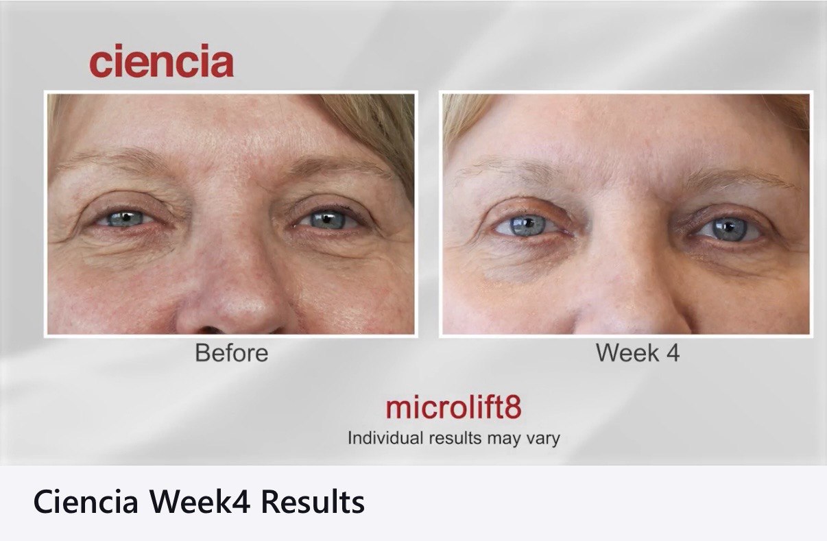 Microlift8 Before and After - Eyes Week 4 Results