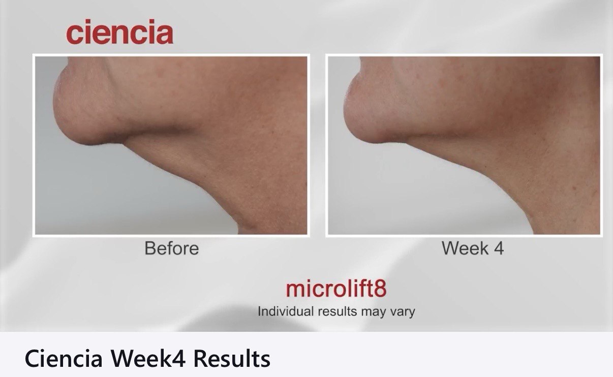 Microlift8 Before and After - Jawline Week 4 Results