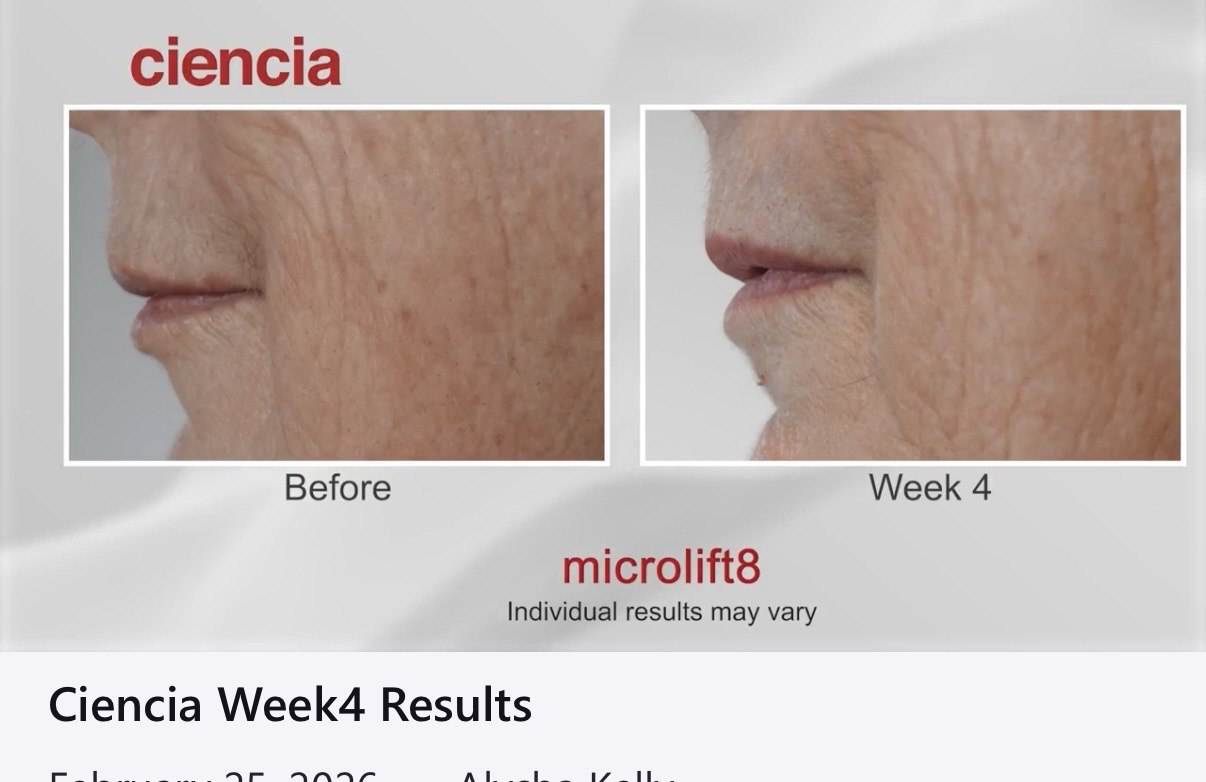 Microlift8 Before and After - Perioral Area Week 4 Results
