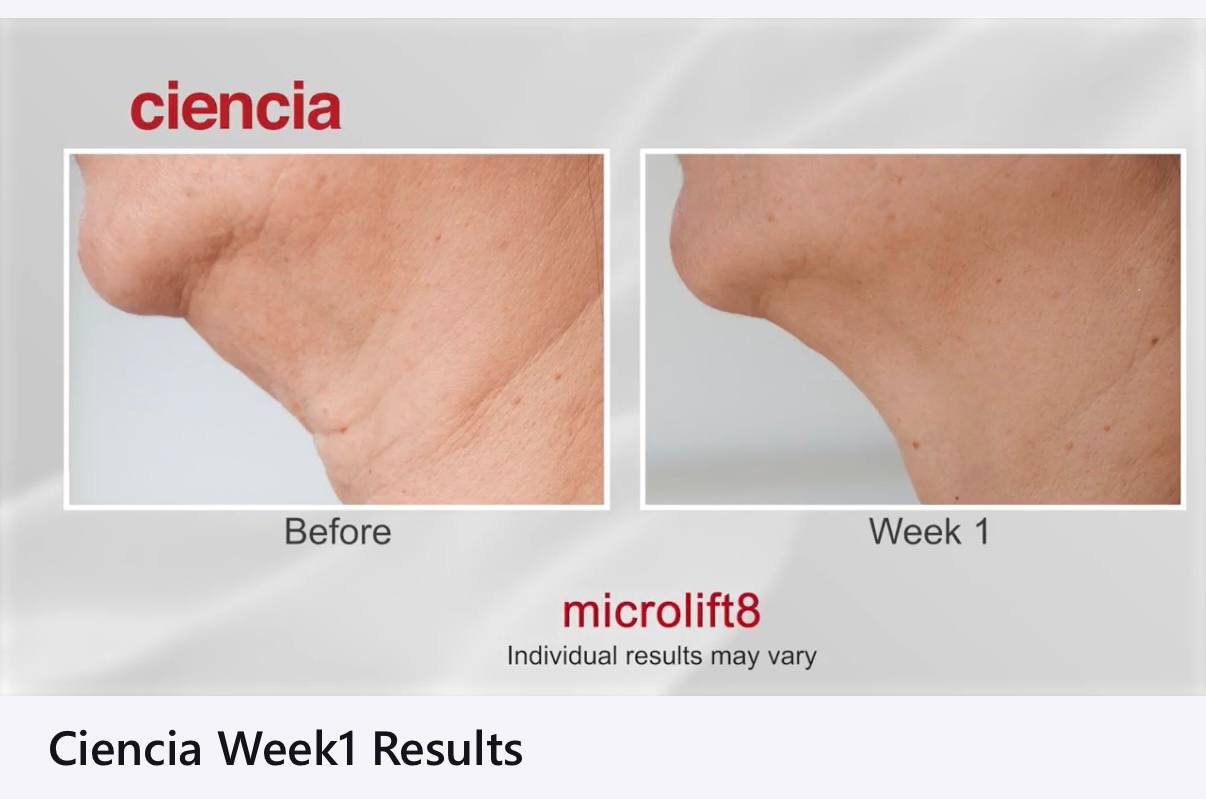 Microlift8 Before and After - Neck and Jawline Week 1 Results