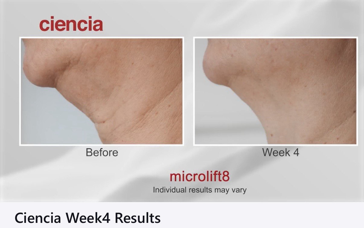 Microlift8 Before and After - Neck and Jawline Week 4 Results