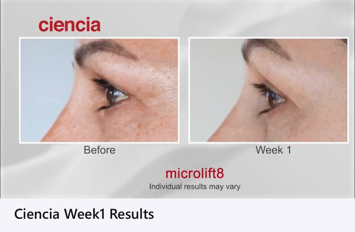 Microlift8 Before and After - Outer Eye Crow's Feet Week 1