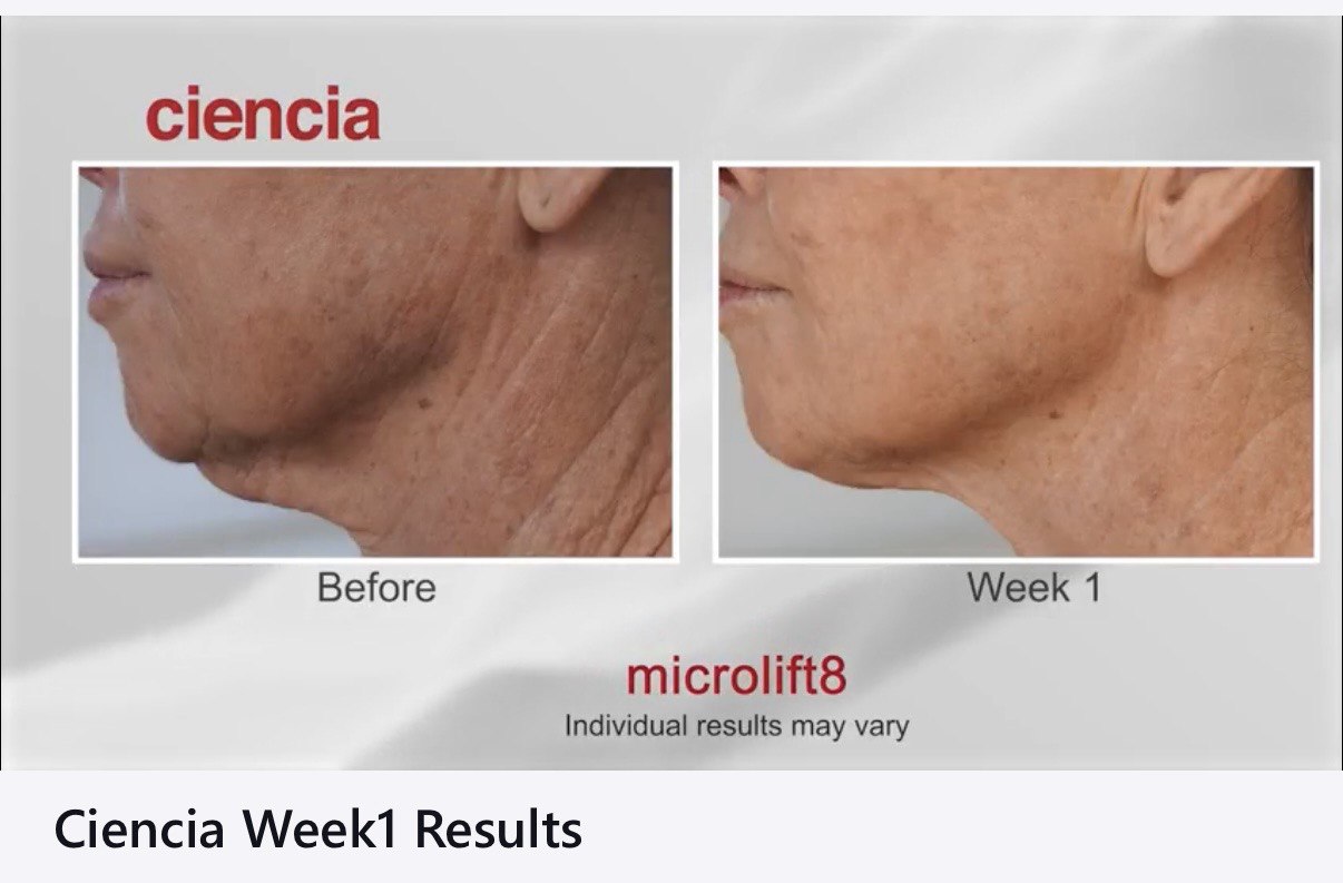 Microlift8 Before and After - Week 1 Results